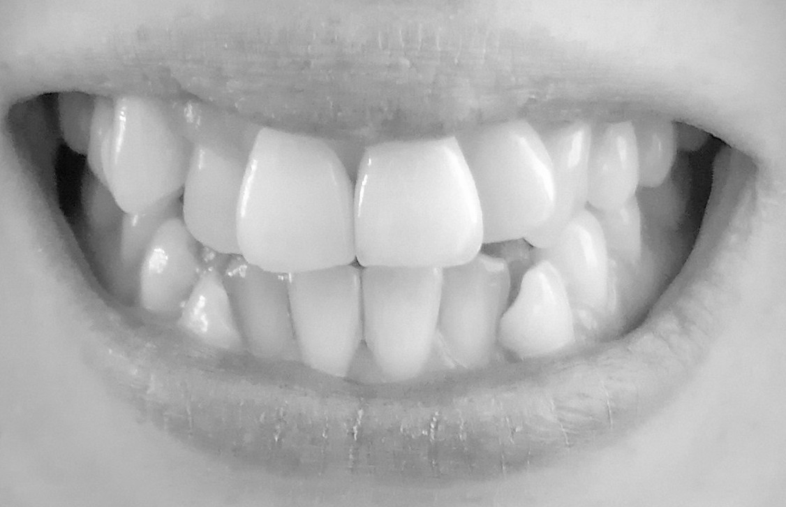 Dentatura affollamento dentale prima di estrazione quattro premolari