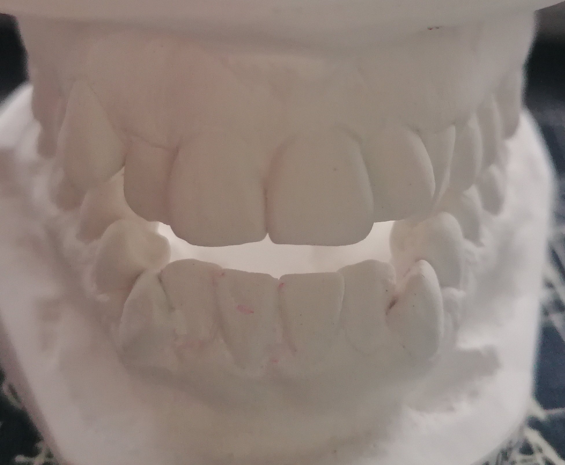 Un calco dei denti frontali con malocclusione
