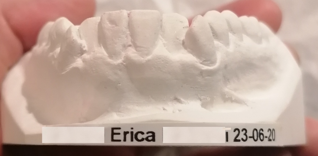 Calco che mostra lato frontale superiore di denti con affollamento e malocclusione